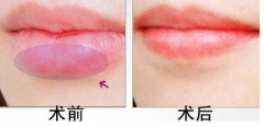 厚唇变薄后能吃刺激性食物吗