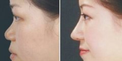 沈阳杏林做隆鼻效果如何?