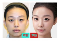 成都开内眼角哪家医院好？