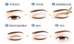 埋线双眼皮与切开双眼皮的区别。