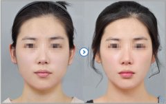 吉林长春哪家医院瘦脸靠谱儿？