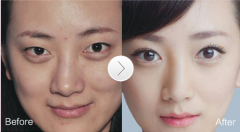乌鲁木齐哪家医院割双眼皮效果好？