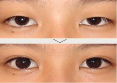 南京哪家医院做双眼皮效果好？