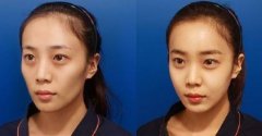 北京哪家医院自体脂肪面部填充效果好？