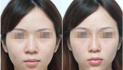 武汉哪家医院线雕隆鼻做得好？