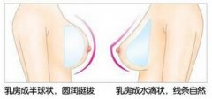 妙桃假体是最好的丰胸材料吗
