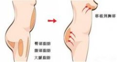 自体脂肪丰胸会不会被吸收