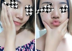 上海公立三甲医院鼻整形面诊经历分享