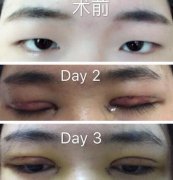 福州附一王彪医生做的全切双眼皮➕开眼角