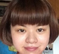 浙一吴慧玲医生做的全切双眼皮