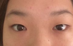 湖南衡阳雅美整形医院姚院长做的全切双眼皮