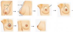 北京乳头乳晕缩小需要多少钱