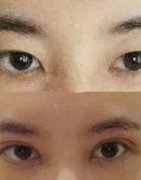 深圳米兰柏羽朱医生做的全切双眼皮+开眼角