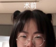 南京维多利亚杨焱做的全切双眼皮+眼角