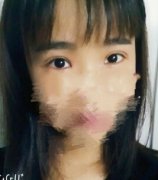 长沙美德思彭青和做的全切双眼皮+开眼角