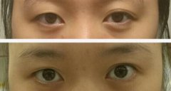 成都市景华美容医院江涛全切，内眼角和提肌
