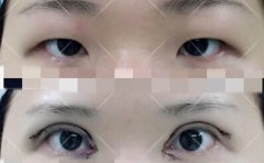 广州华侨医院卢金强医生做的全切双眼皮+开眼角