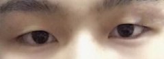 成都铜雀台徐敦全切+上睑下垂矫正+开眼角