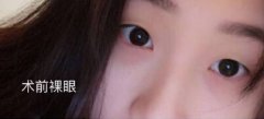 北京八大处整形医院尹宏宇切开法双眼皮手术