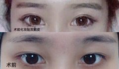 长沙伊美刘芳医生做的全切双眼皮