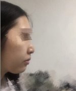 乌鲁木齐某整形医院买的海薇玻尿酸套餐