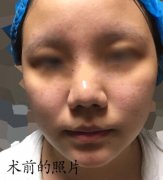 长沙伊美整形唐中华做的全面部吸脂