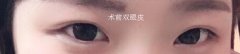 安徽省立医院赵李平做的全切双眼皮+开眼角