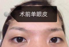 上海九院周一雄医生双眼皮