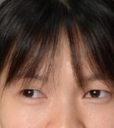 武汉卓美整形医院王海平微创双眼皮项目