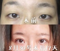 北京同仁医院孙强医生全切双眼皮