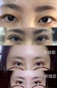 江苏省中医院王金明医生全切双眼皮