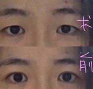 上海九院罗敏医生做的双眼皮