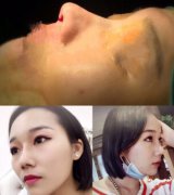 南昌大学第一附属医院文辉才肋软骨鼻综合