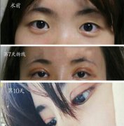 长沙伊美陈铁夫全切双眼皮+开眼角+提肌