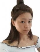 【广州美莱医学美容真人案例】做了鼻综合