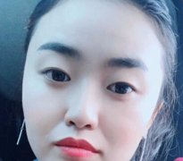做完双眼皮已经2年多了