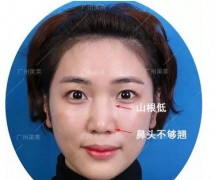 广州美莱做了线雕隆鼻案例恢复过程