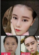 重庆美伽刘怀朴做鼻子好看吗，案例