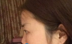 上海百达丽谈宇腾做的隆鼻效果怎么样【案例】