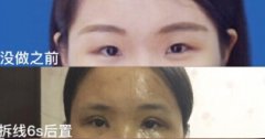 湖南省人民医院李波医生做的双眼皮+内眼角案例