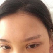 武汉天佑医院孔伟做韩式三点微创双眼皮案例分