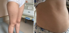 广州美莱张毓怎么样？大腿和腹部吸脂案例分享