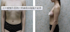武汉中爱整形医院付荣峰假体隆胸案例术后恢复