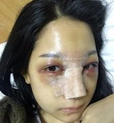 我的隆鼻经历，是公立三甲医院～