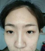 广西南宁某三甲医院做的双眼皮+开眼角