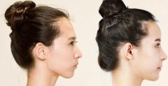 北京自体脂肪隆鼻有效果吗？怎么样价格案例对