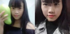 北京禾美嘉割双眼皮美肤案例日记对比照怎么样