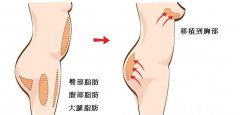 自体脂肪丰胸安全吗？需要住院吗自体隆胸有害