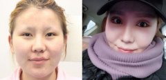 北京做面部吸脂效果怎么样？多少钱？