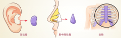 隆鼻会留疤吗？是永久的吗？需要取出来吗?